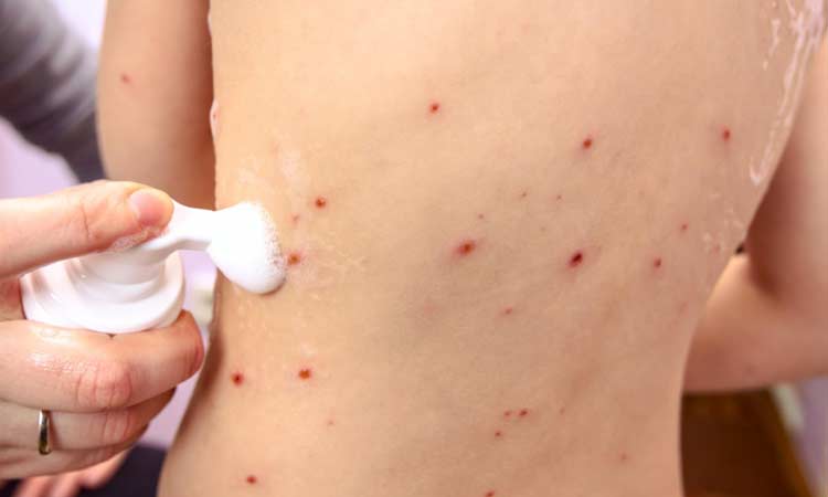 Confirmados três novos casos de varíola dos macacos na Bahia