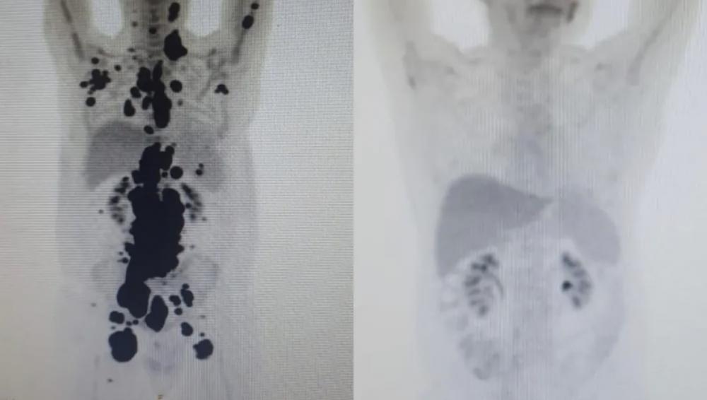 Paciente com câncer há 13 anos tem remissão completa em SP em um mês após terapia celular em estudo na rede pública