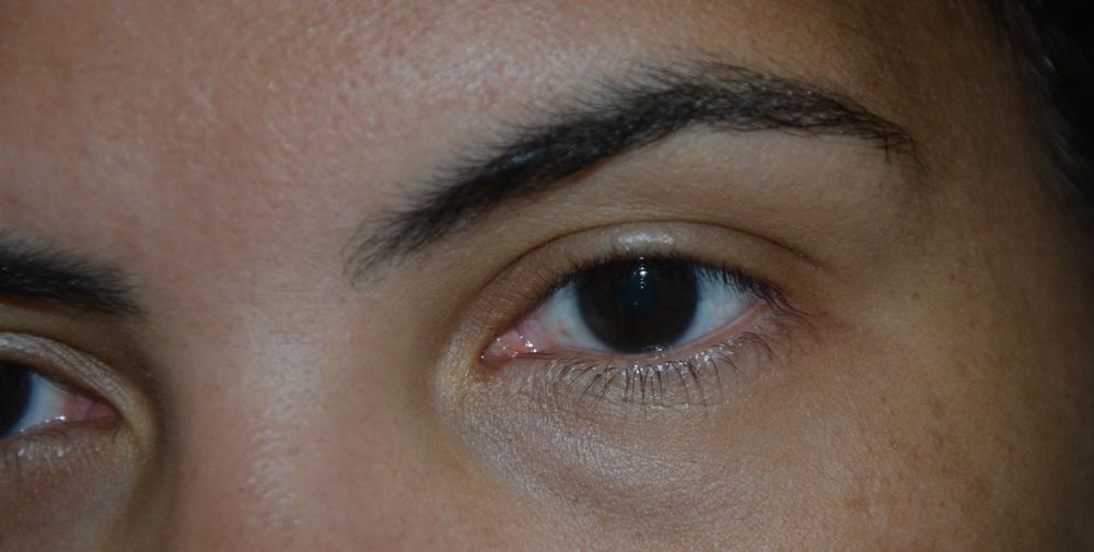 Prefeitura de Feira promove mutirão de exames de glaucoma com 400 vagas