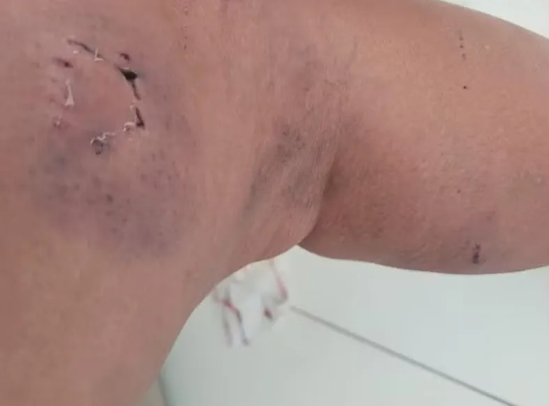 Agente de saúde é atacada por seis cães em Feira de Santana