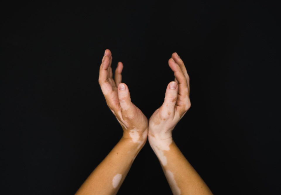 Prefeitura de Feira institui Semana Municipal de Conscientização e Orientação sobre Vitiligo