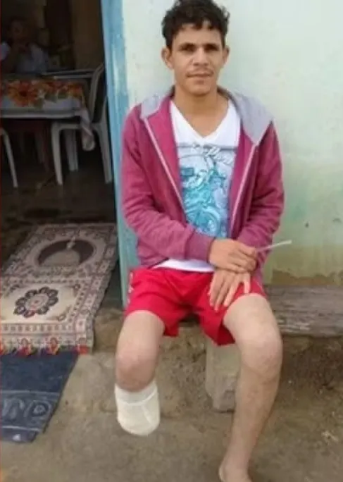 Servidor que amputou o próprio pé alegou que perdeu membro em sequestro