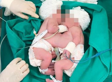 Morre uma das gêmeas siamesas separadas por cirurgia em Salvador