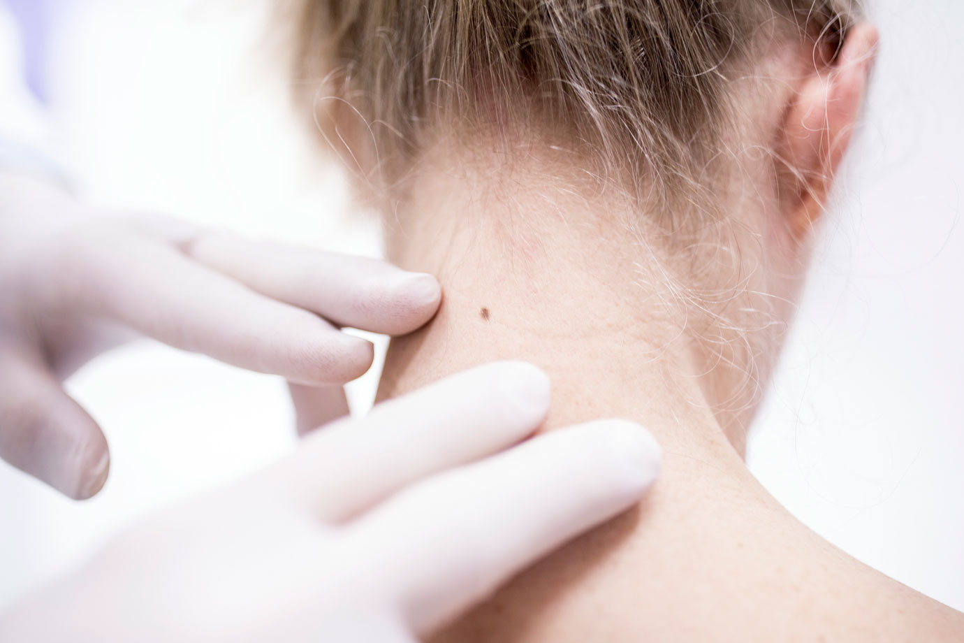 Conheça os tipos de câncer de pele e saiba como se prevenir