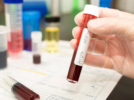 Pandemia da Covid reduz testes de HIV e atrasa tratamento com antirretroviral