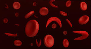 Hemácias de uma pessoa com anemia falciforme. Foto: Reprodução / Internet