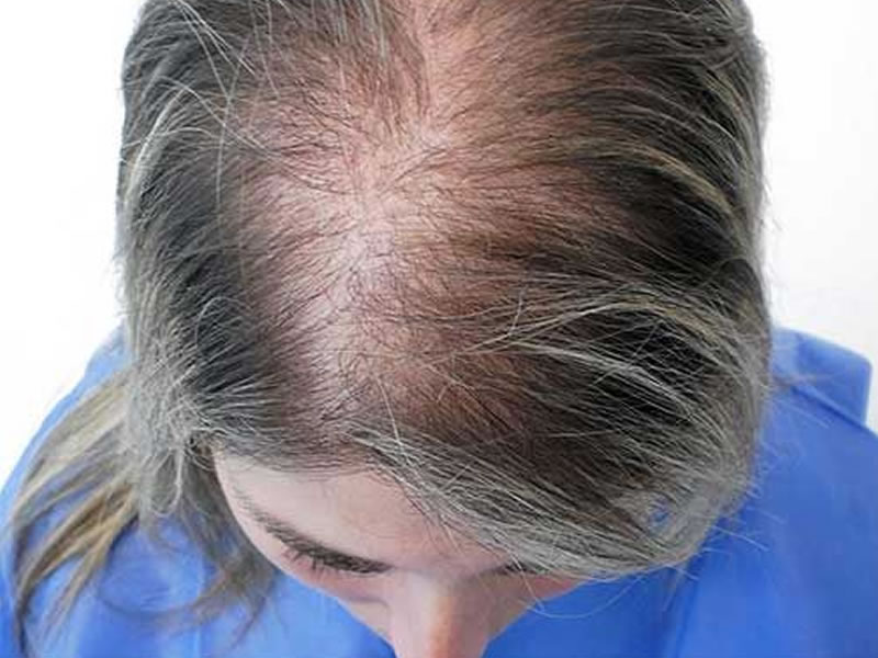 Dermatologista fala sobre calvície feminina